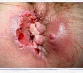 Cancer de l'uterus